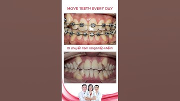 Niềng răng khâp khểnh | Bác sĩ Thu Gia Lâm