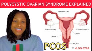 POLYCYSTIC OVARIAN SYNDROME /PCOS/ IRREGULAR MENSTRUATIONS/ CAUSES