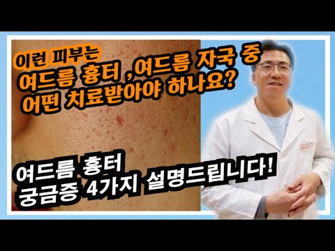 여드름 흉터에 대한 궁금증 4가지 알려드립니다!!! (여드름 자국X)