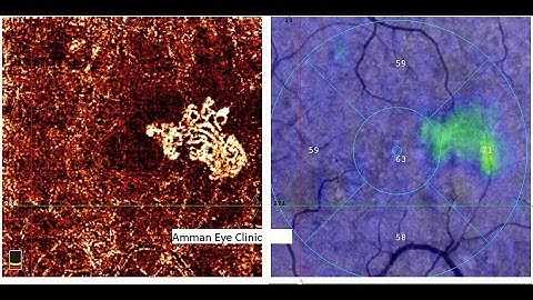 Choroidal Neovascularisation-Accidental finding