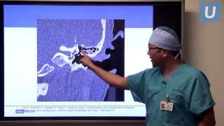 New Treatment for Superior Semicircular Canal Dehiscence  Isaac Yang, MD | UCLAMDChat