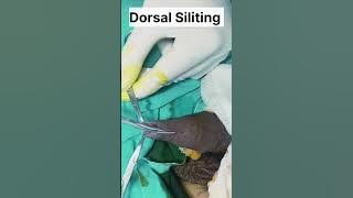 'Effective Treatment for Phimosis: Laser Circumcision by Top Doctors'