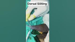 'Effective Treatment for Phimosis: Laser Circumcision by Top Doctors'