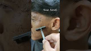scar Atrofi alias model bopeng karena bekas jerawat. #barbershop #skincare #agne #america