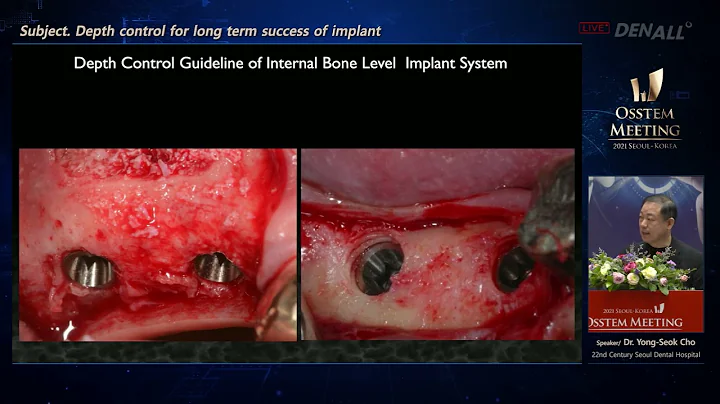 Depth control for long term success of implant    ...