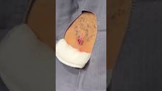 Wait Until You See This Armpit Cyst Removal