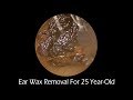 Compilation Of Ear Wax Removal For 20 Years Old