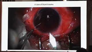 AIOC2026-IC184 - Dr Aniruddha Maiti Management of Intra-operative Surprises in Severe Ocular Inju