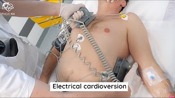 Electrical cardioversion