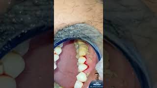 أسباب رائحة الفم الكريهة | اسباب نزيف اللثه|removal dental tartar |scaling and polishing #dentist