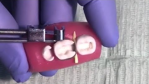 tofflemire matrix band placement For Class II amalgam Basic Arabic Explanation