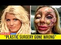 10 Famous Celebrities Unrecognizable After Plastic Surgery Gone Wrong.