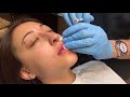 Pouty lip injections with Restylane