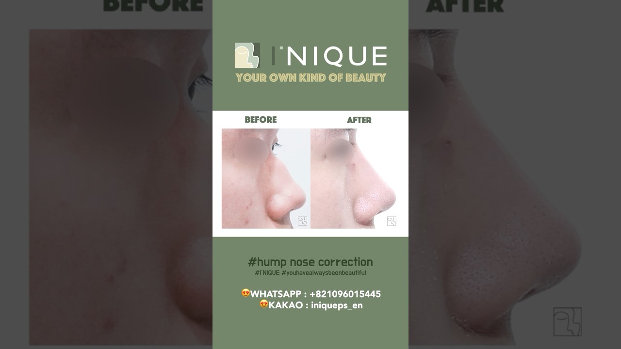 Hump Nose Correction 