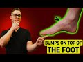 Bone Spur on Top of the Foot  [Treatment for Bumps & Lumps!]