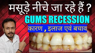मसूड़े के नीचे जाने का इलाज || Gums Recession Causes ,Treatment || can receding gums grow back ?