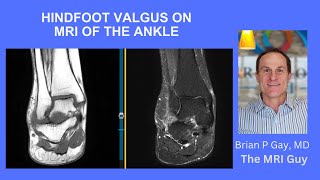 Hindfoot valgus on MRI