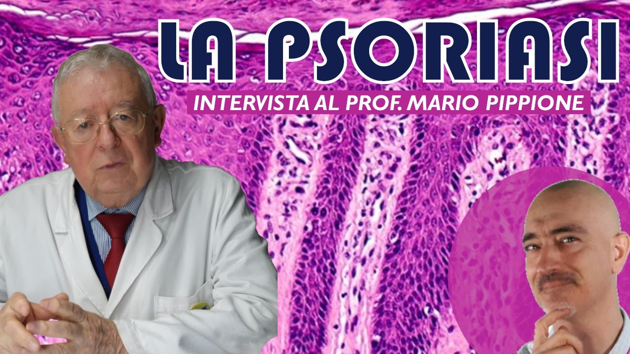 TUTTE LE FACCE DELLA PSORIASI - intervista al Professor Mario Pippione