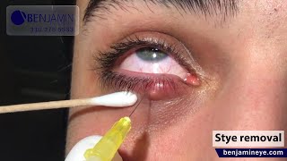 Styes may require surgical intervention to drain the pus and alleviate pressure on the eyelid