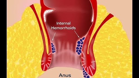 Hemorrhoids (Piles) | Thrombosed | Pectinate line| Sphincteroplasty - Dr Rams Medical Coding Academy