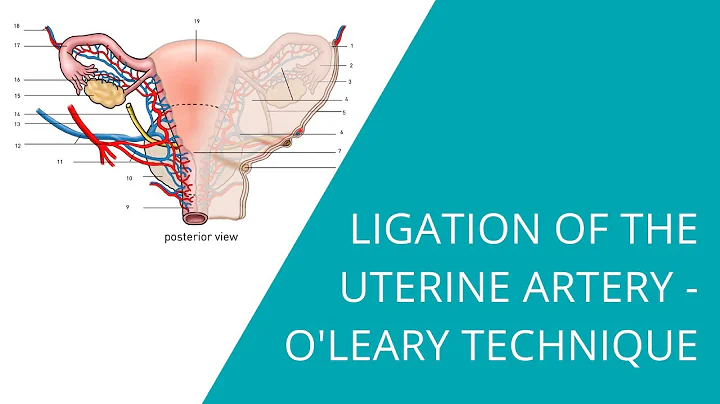 Ligation of the Uterine Artery - O'Leary Technique