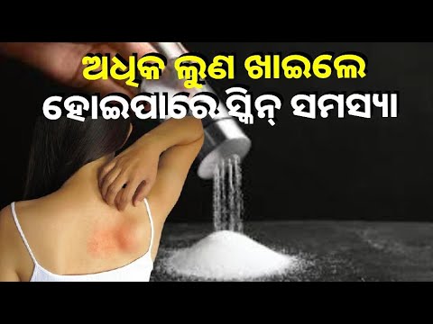 ଅଧିକ ଲୁଣ ଖାଉଛନ୍ତି କି ? ସାବଧାନ ହୋଇପାରେ ଏକ୍ଜିମା ଭଳି ସ୍କିନ୍‌ ସମସ୍ୟା