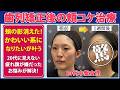 【症例解説】歯列矯正後の頬コケ改善|かわいい系の顔になるには?