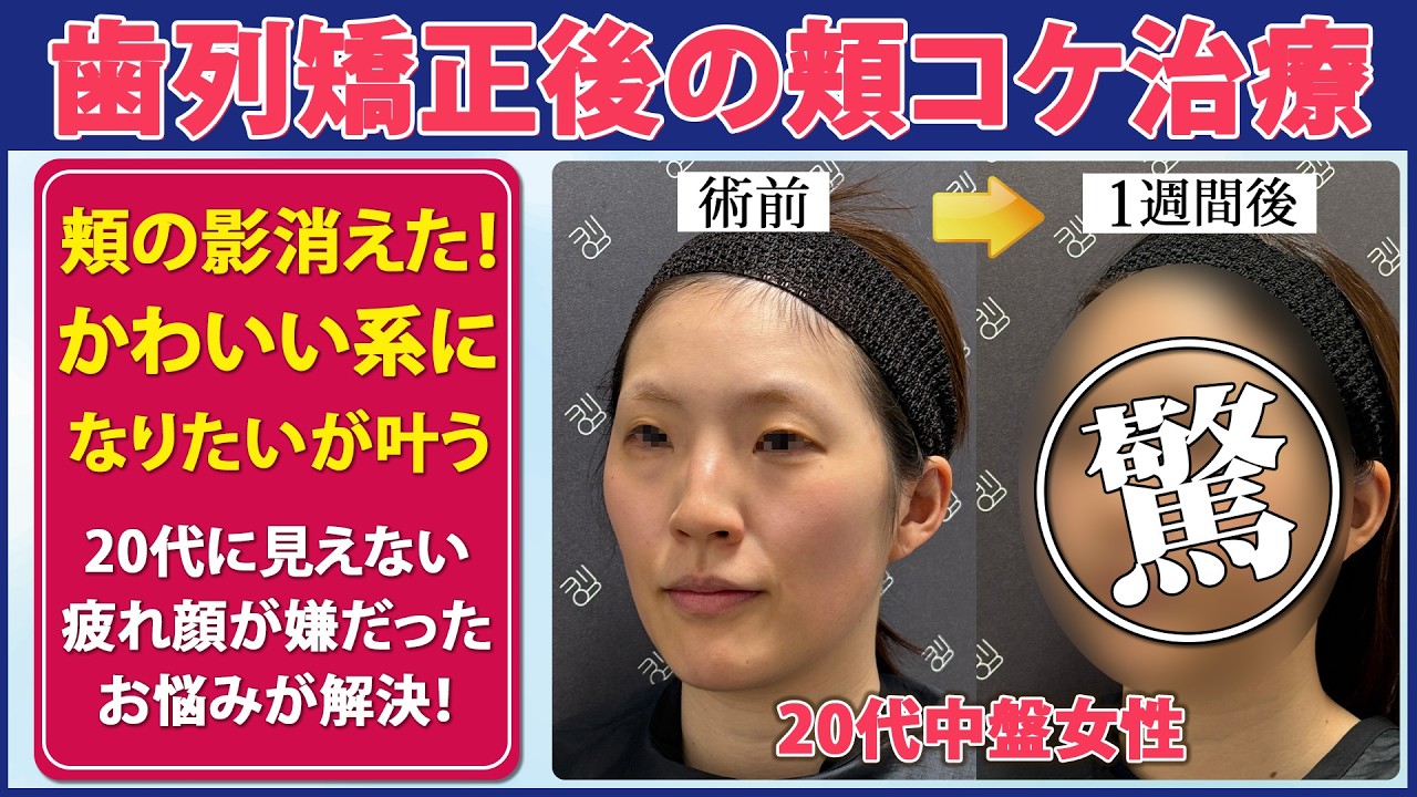 【症例解説】歯列矯正後の頬コケ改善|かわいい系の顔になるには?