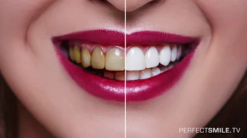 Kann man Zähne verschönern?