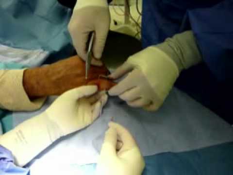 Dynamic PIP external fixation