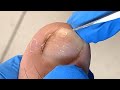 Pedicure Tutorial: Toenail has a large piece of nail at the base, pull it out completely【Xue Yidao】