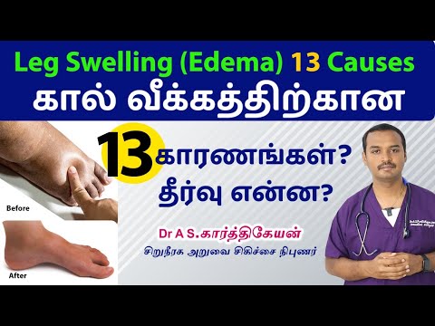 13 causes of  Leg swelling (Edema) | கால் வீக்கத்திற்கான 13 காரணங்கள்? தீர்வு என்ன?
