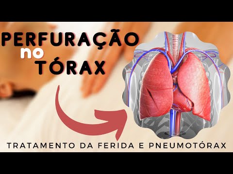 Vídeo: Pneumotórax - Causas, Tratamento, Primeiros Socorros