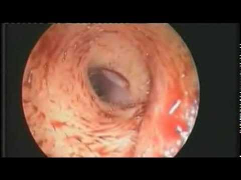 Doctors Find Fruit Fly Larvae Inside Woman's Ear - YouTube