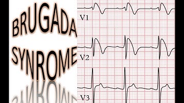 Đọc Điện tâm đồ(ECG): video 27: Hội chứng Brugada