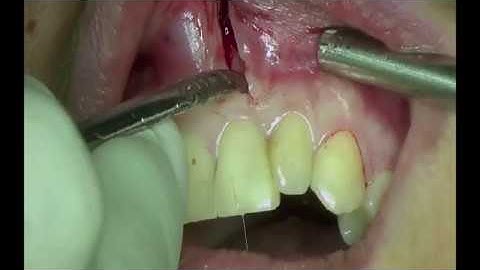 Apicoectomy via Hockey Stick Incision. MTA Retrograde Root Canal Filing