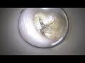 【耳そうじ】Vol.24 デイサービス訪問 90代男性Earwax removal professional earcleaning&headspa salon Kaleidscope TOKYO
