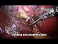 Laparoscopic cholecystectomy  gall bladder surgery  education  punjab  india  dr ahluwalia