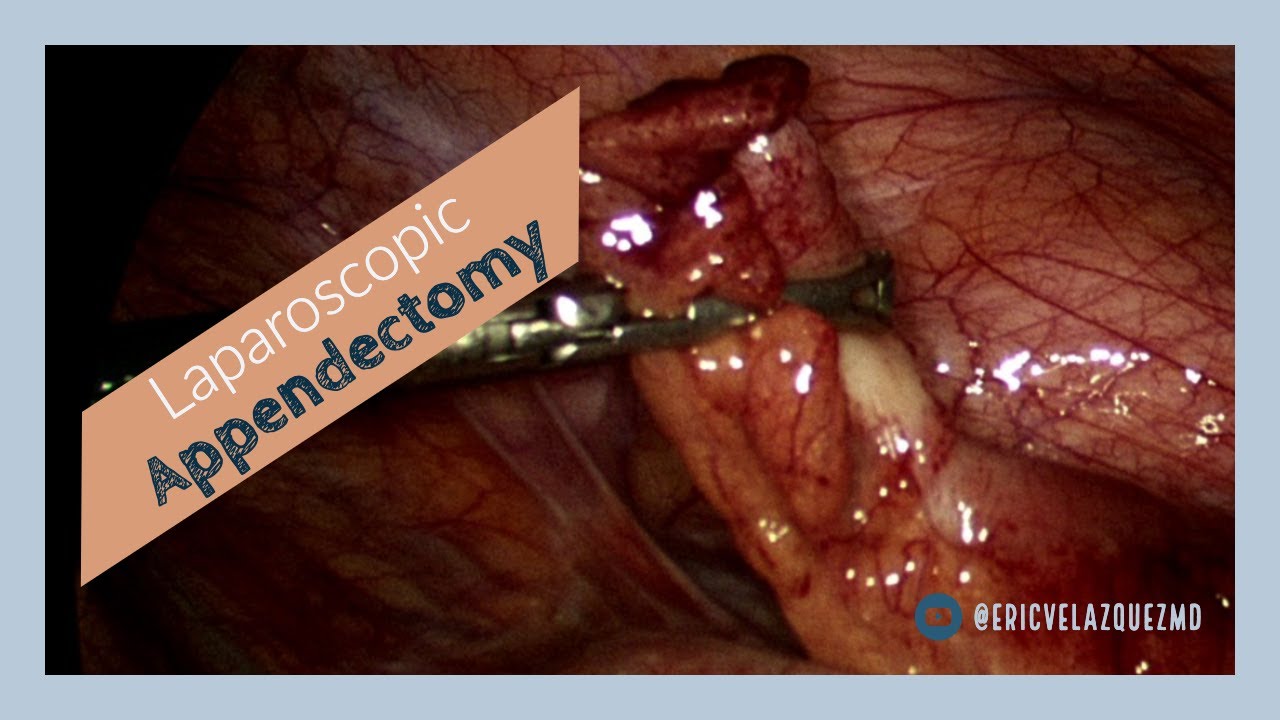 Laparoscopic Appendectomy YouTube