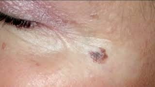 Melanoma Monday Highlights The Deadliest Form Of Skin Cancer