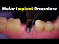 Step by step dental implant procedure  back molar