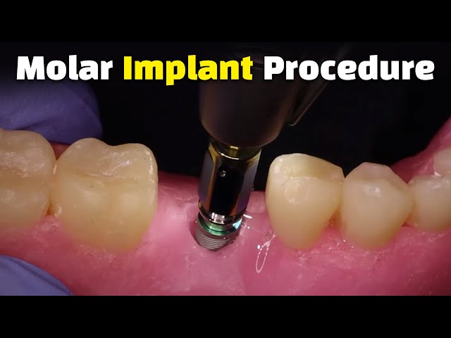 Step by Step Dental Implant Procedure - Back Molar class=