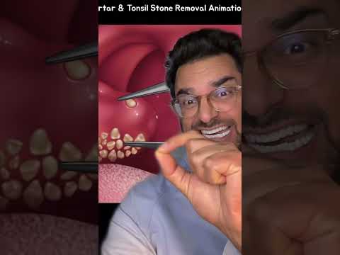 Tonsil stones removal ASMR 🦷😳 major bad breath 😷