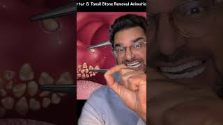 Tonsil stones removal ASMR 🦷😳 major bad breath 😷 screenshot 4