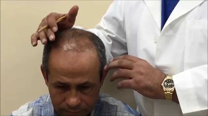 Hair Transplantation - 3000 Neografts with Baldev ...