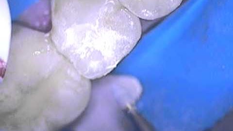 Class II Composite Restoration using a dental microscope - Boca Raton, Florida 3/3