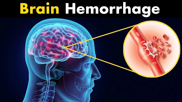 What Happens in Brain hemorrhage? | Symptoms, Causes and Treatment (3d animation) - DayDayNews