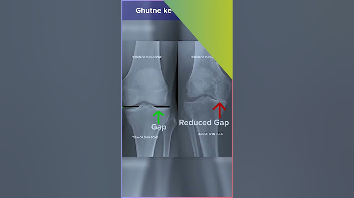 घुटने में गैप (OsteoArthritis) | Knee Reduced Gap by Pain Specialist Dr Amod Manocha