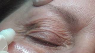 Non-Invasive Blepharoplasty with Plexr