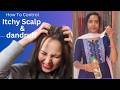 Best Home Remedy To Control ITCHY SCALP &amp; DANDRUFF தமிழ் . #itchyscalp #dandruff #youtubevideos